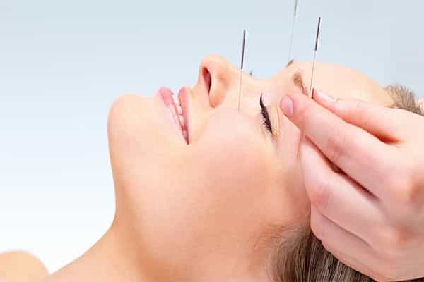Acupuncture
